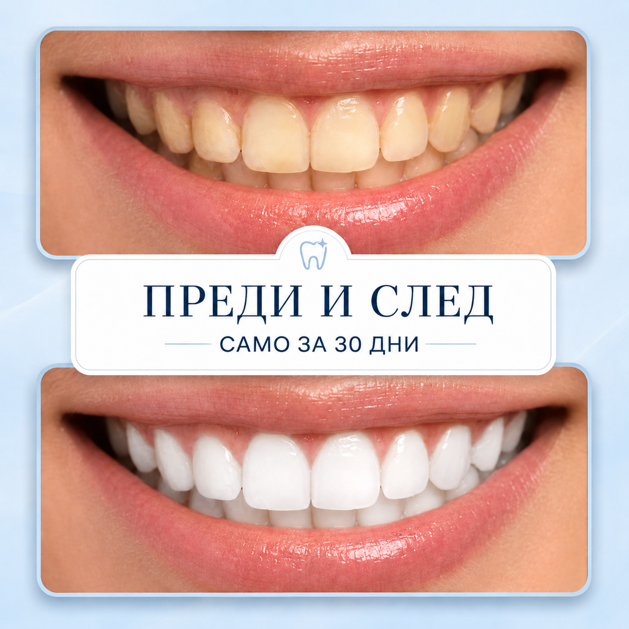 HaloWhite™ LED Комплект за Избелване на Зъби